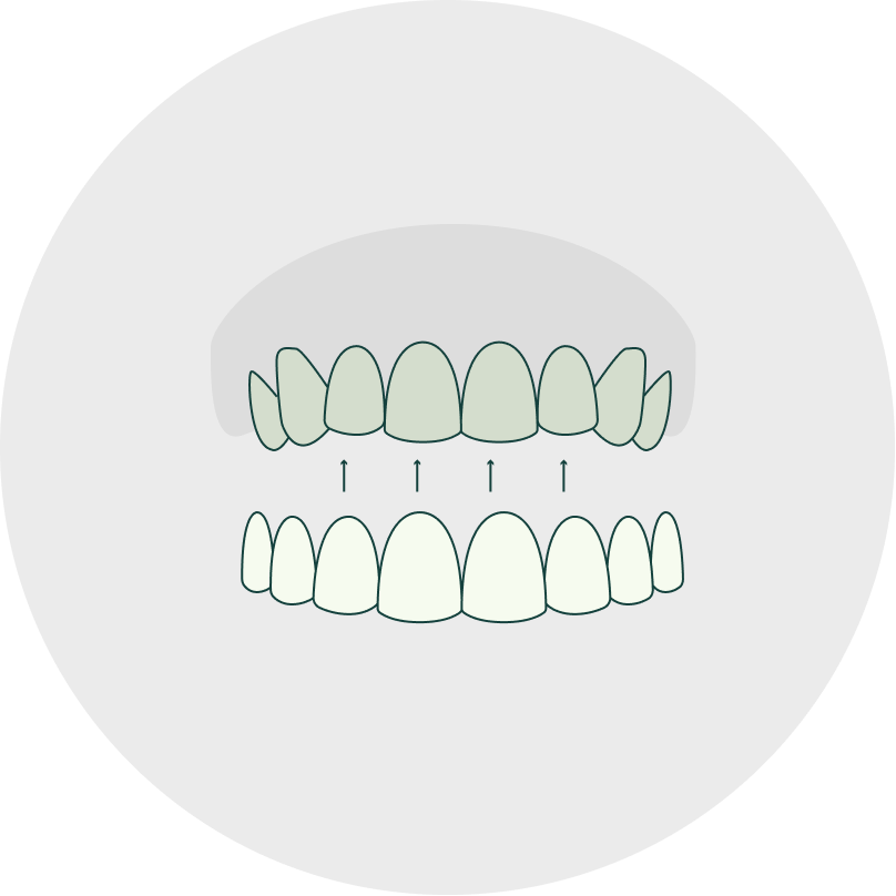 dental veneers toowoomba