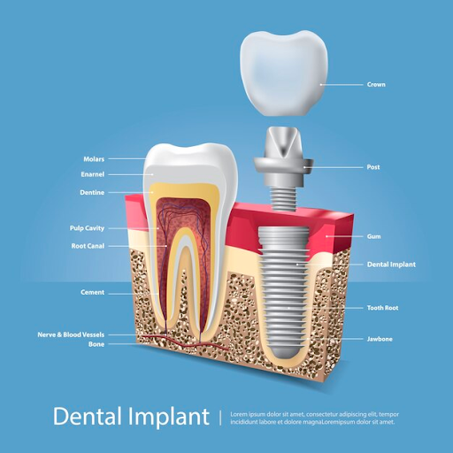 Dental implants