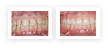 dental-implant