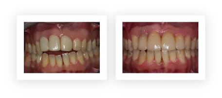 dental-implant