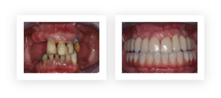 dental-implant